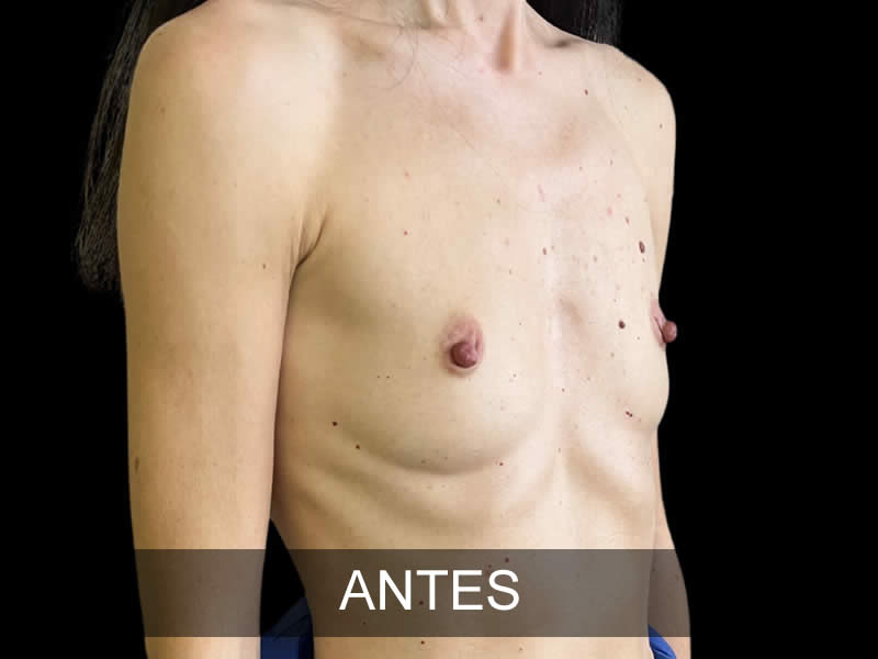 aumento-armonia-11-antes