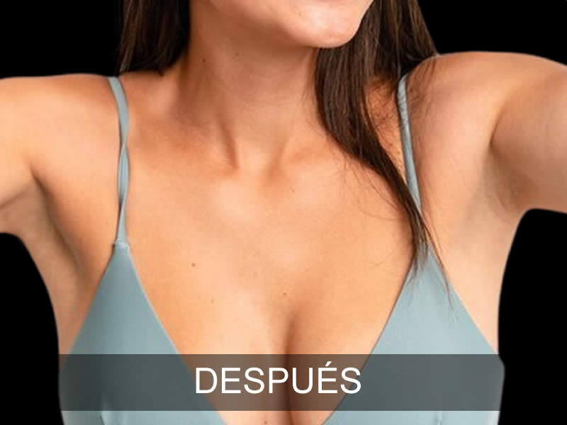 aumento-armonia-4-despues-e