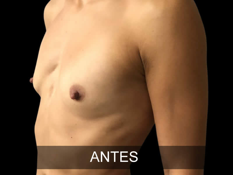 aumento-armonia-6-antes