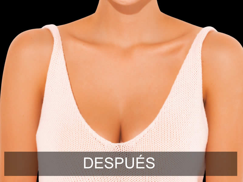 aumento-armonia-6-despues-e