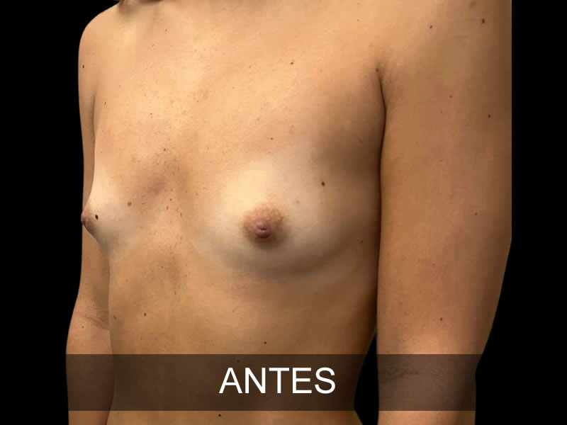 aumento-armonia-8-antes
