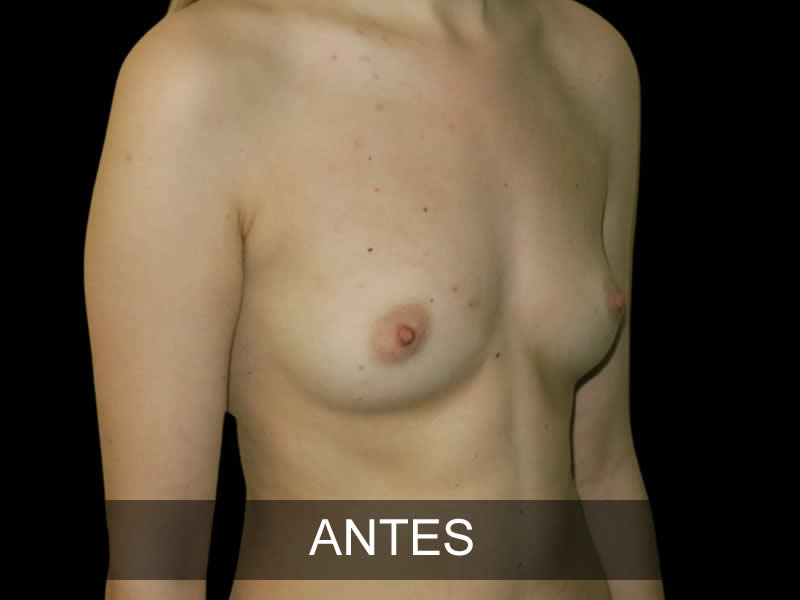 aumento-elegance-1-antes