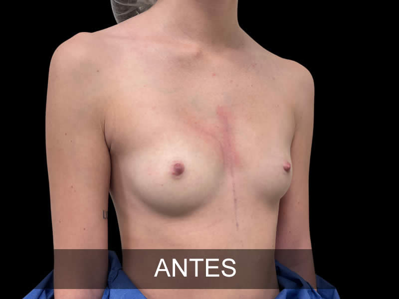 aumento-elegance-5-antes