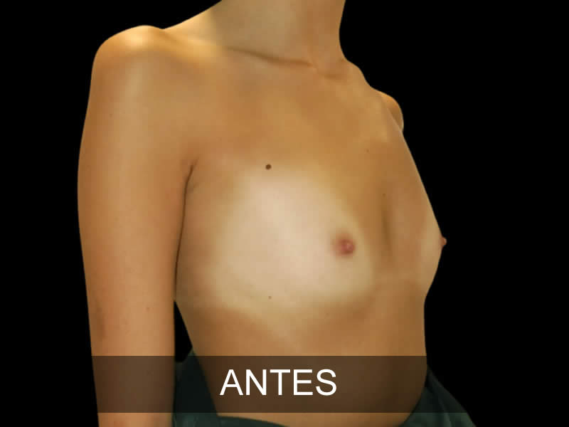 aumento-elegance-6-antes
