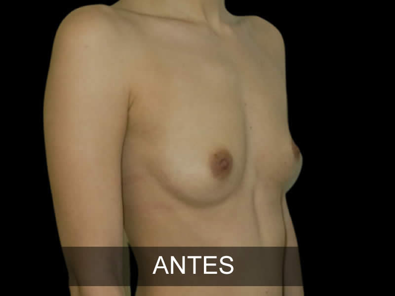 aumento-elegance-7-antes