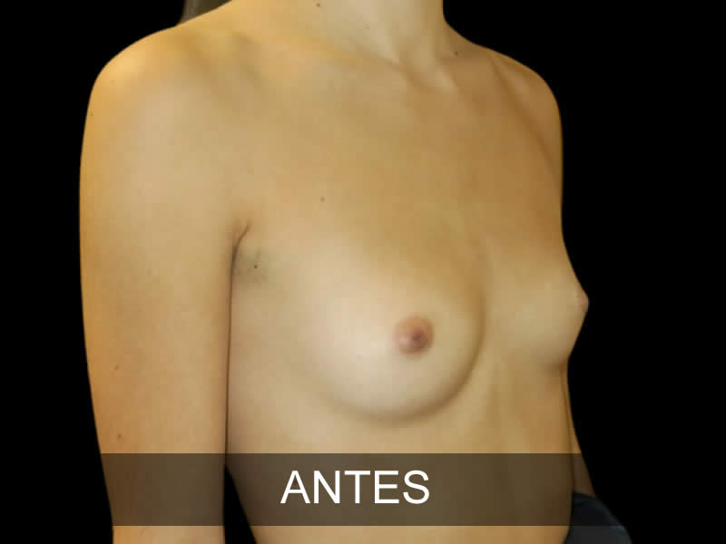 aumento-elegance-9-antes