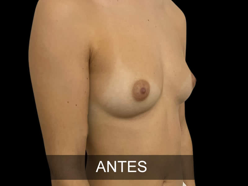 aumento-magnifico-5-antes