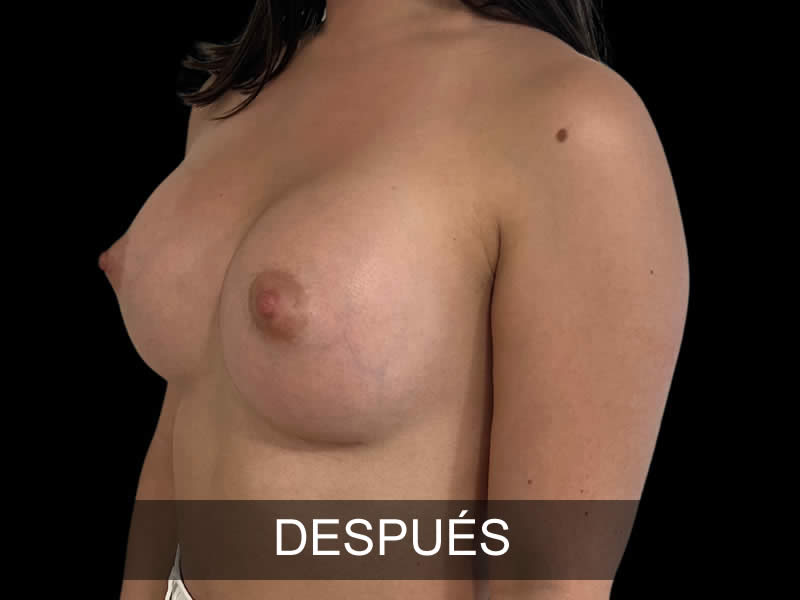 aumento-sublime-10-despues