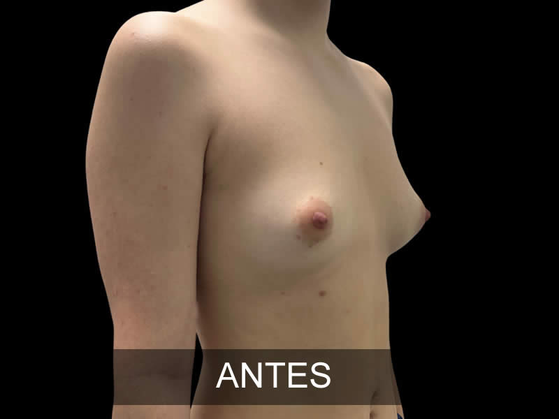 aumento-sublime-12-antes