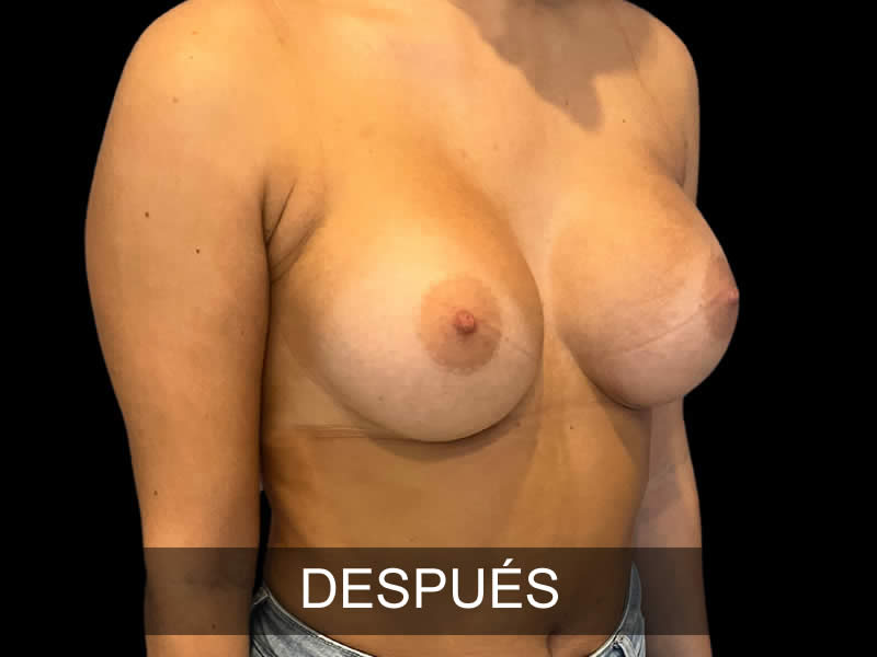 aumento-sublime-2-despues