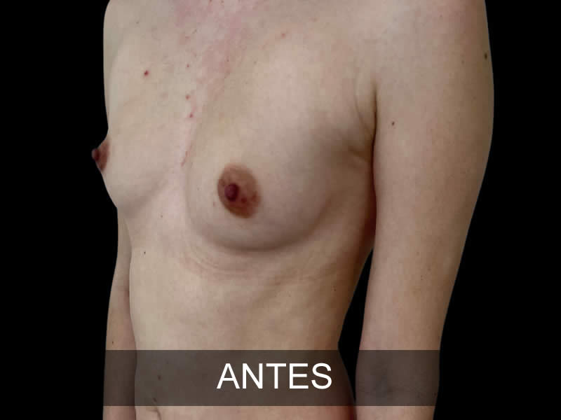aumento-sublime-9-antes
