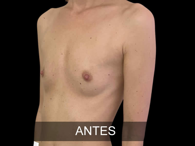 aumento-sutil-2-antes