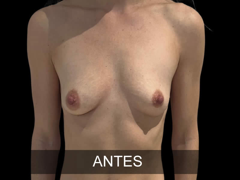 aumento-sutil-4-antes