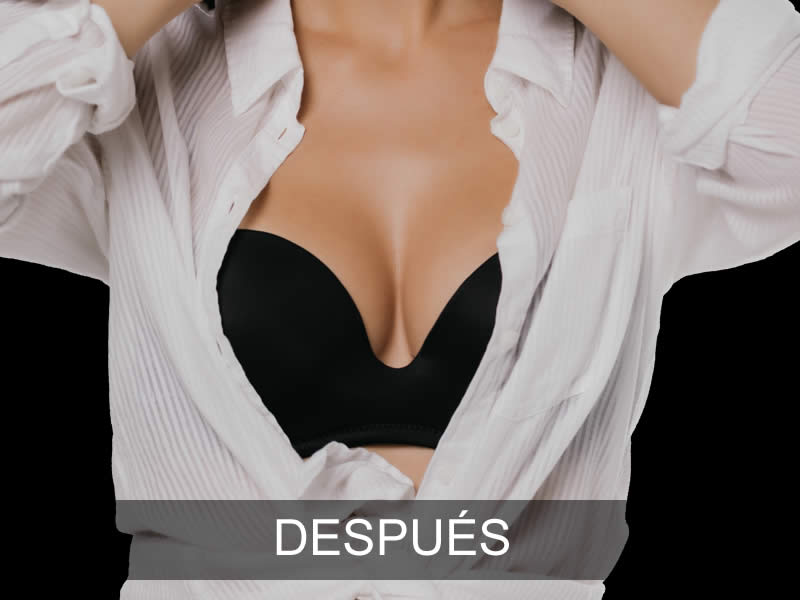 aumento-sutil-4-despues-e