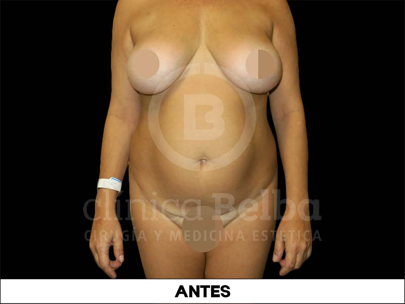Abdominoplastia Antes