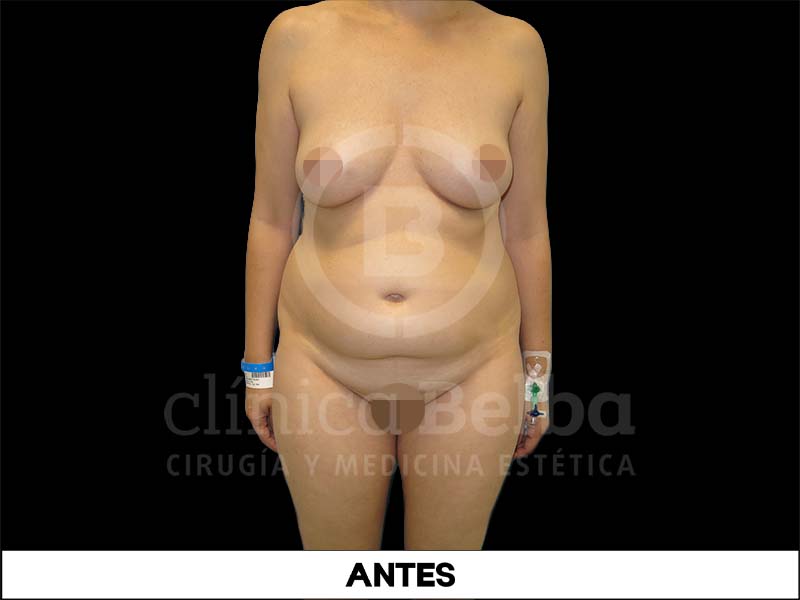 Abdominoplastia Antes