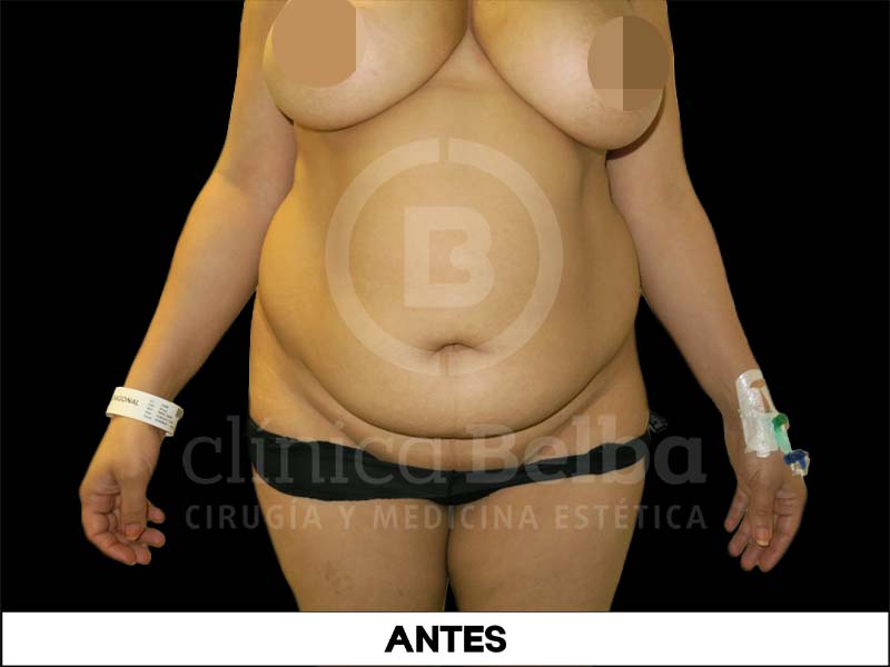 Abdominoplastia Antes