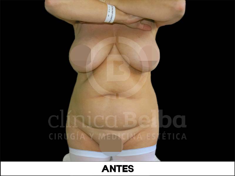 Abdominoplastia Antes
