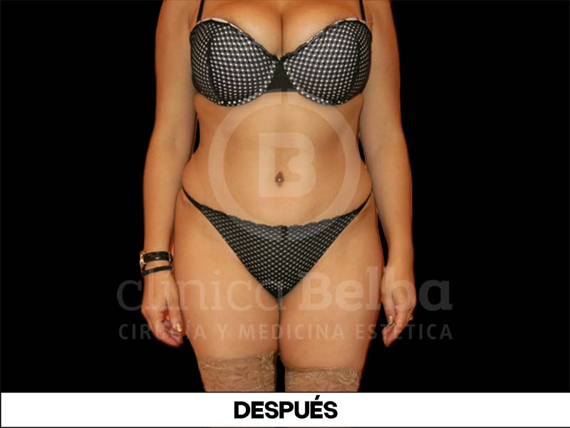 Abdominoplastia Despues