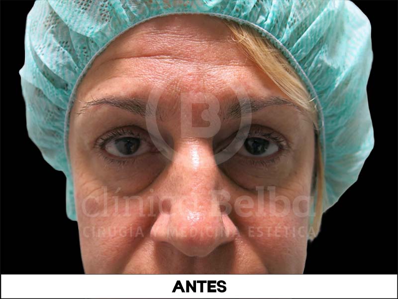 BelbaBlefaroplastiaAntes1