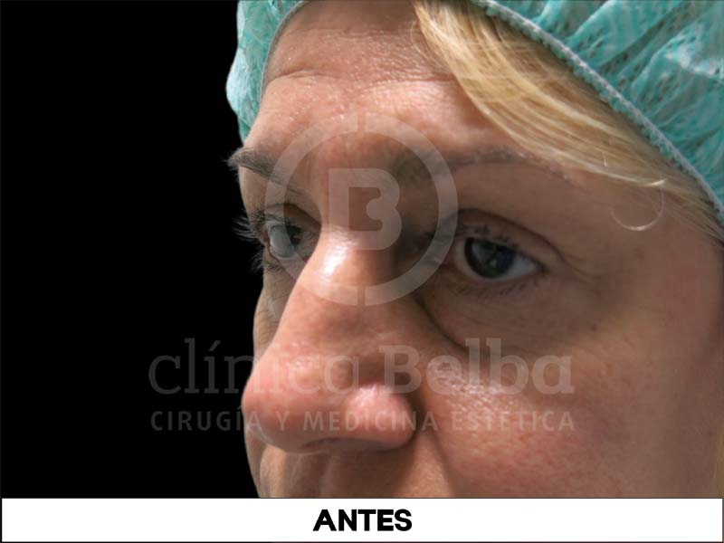 BelbaBlefaroplastiaAntes2