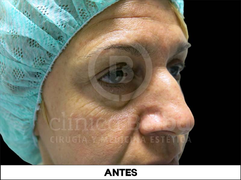 BelbaBlefaroplastiaAntes3