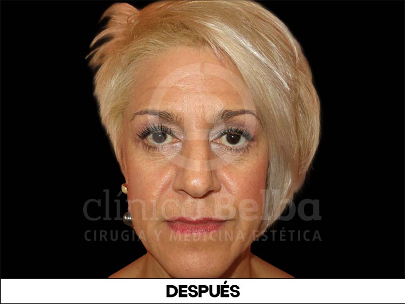 BelbaBlefaroplastiaDespues1