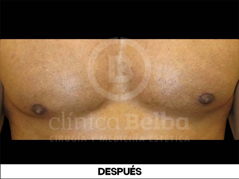 BelbaGinecomastiaDespues3