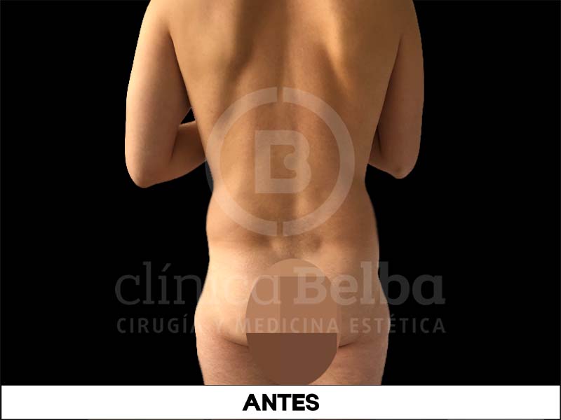 BelbaLiposuccionAntes1