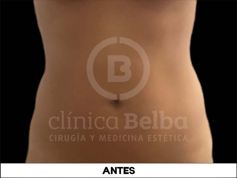 BelbaLiposuccionAntes2