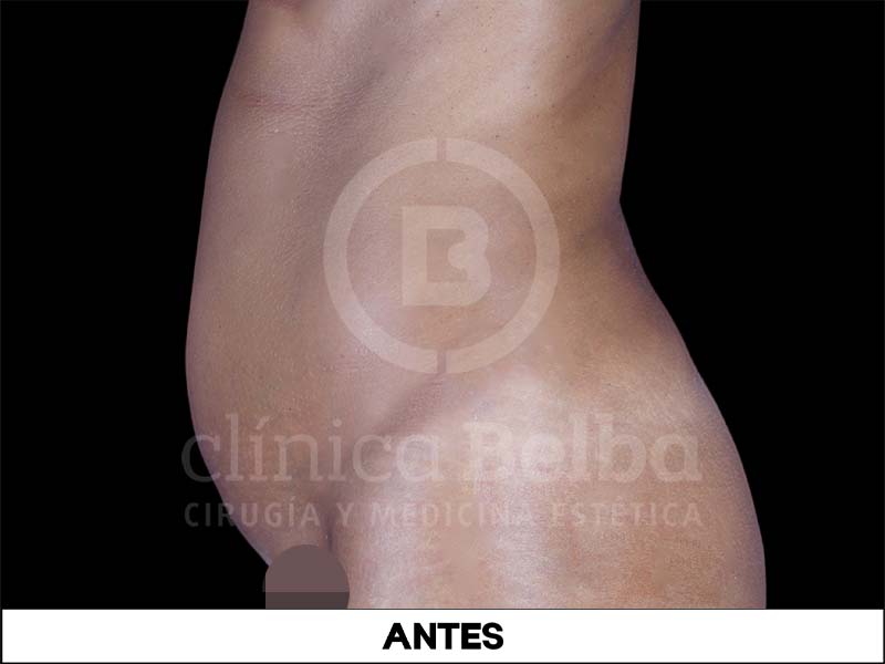 BelbaLiposuccionAntes3