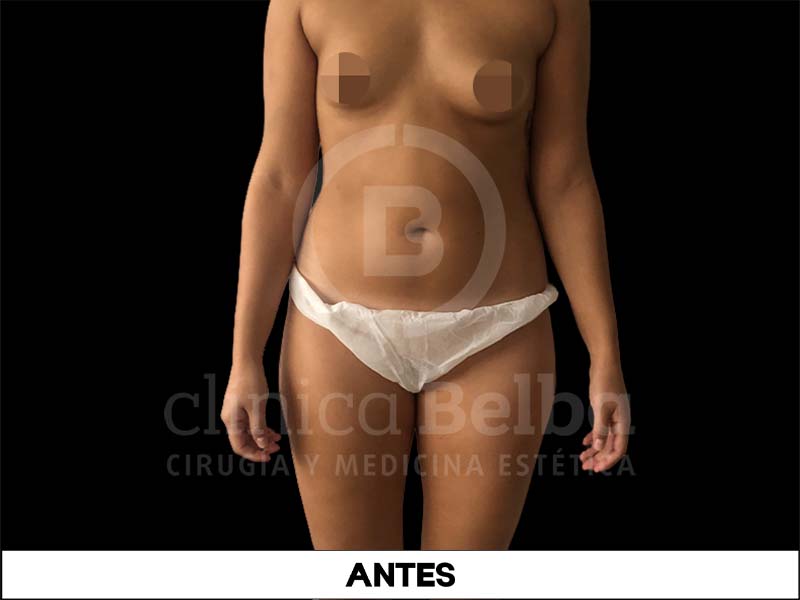 BelbaLiposuccionAntes4