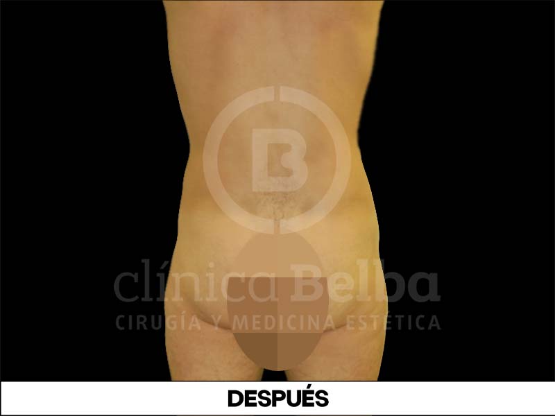 BelbaLiposuccionDespues1