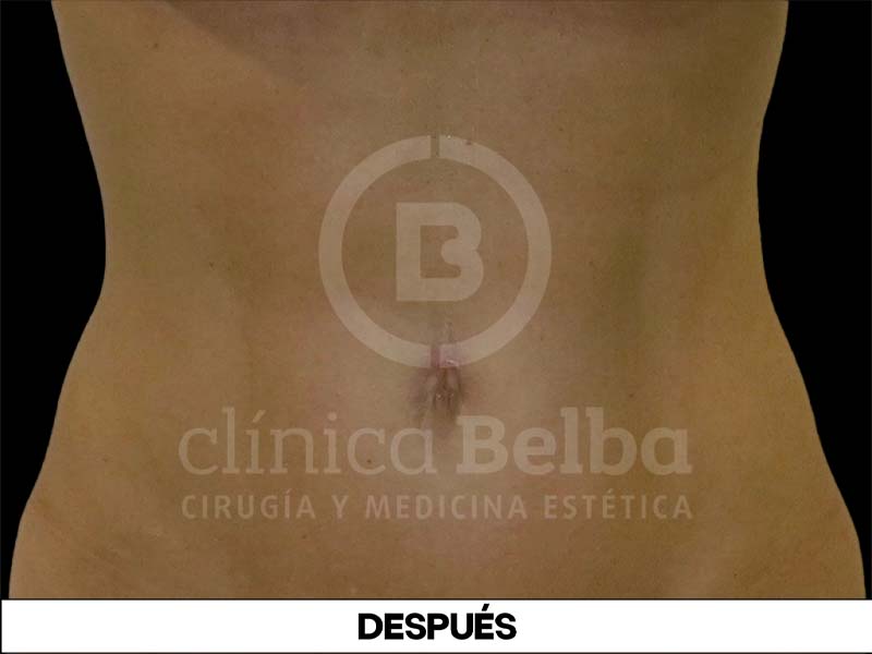 BelbaLiposuccionDespues2
