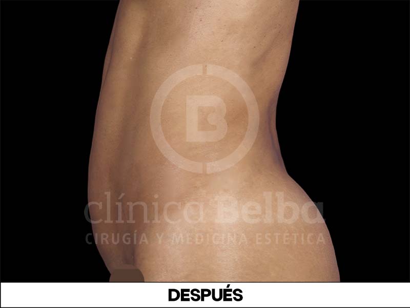 BelbaLiposuccionDespues3