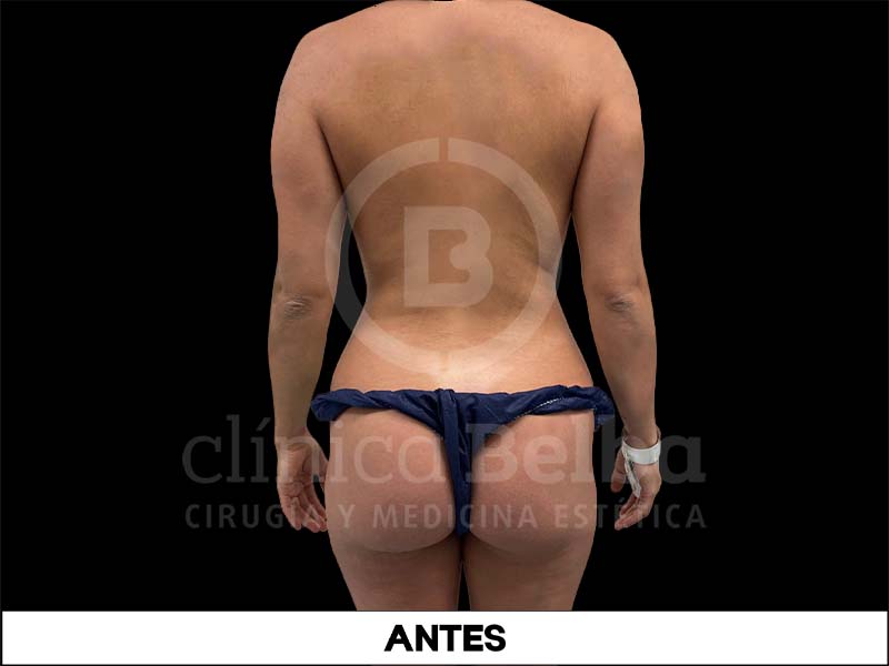 BelbaRemodelacionCostalAntes1