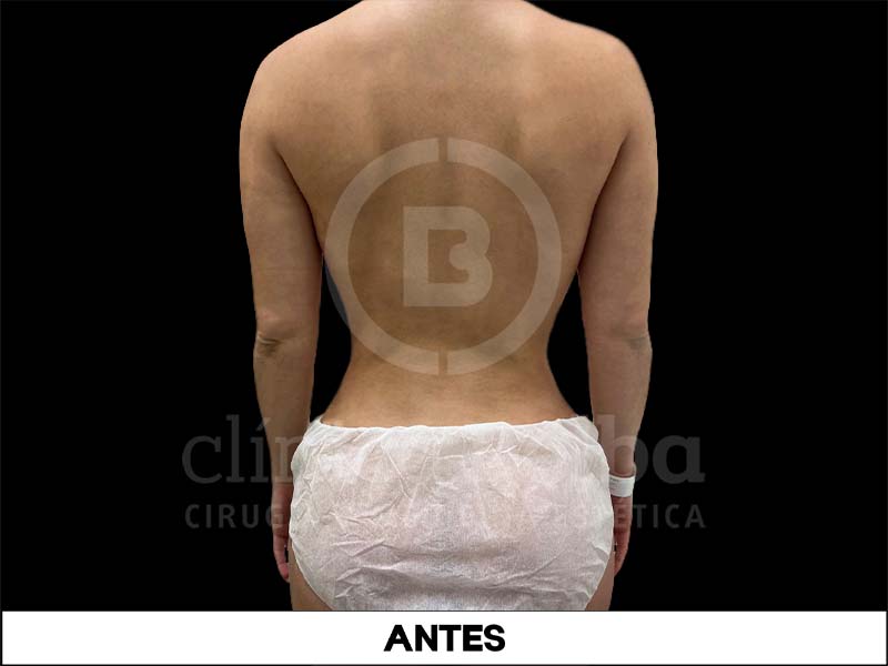 BelbaRemodelacionCostalAntes2