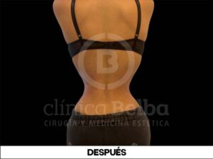 luxación de costillas antes y después