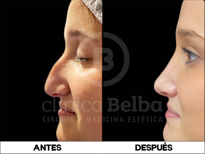 BelbaRinoplastia1