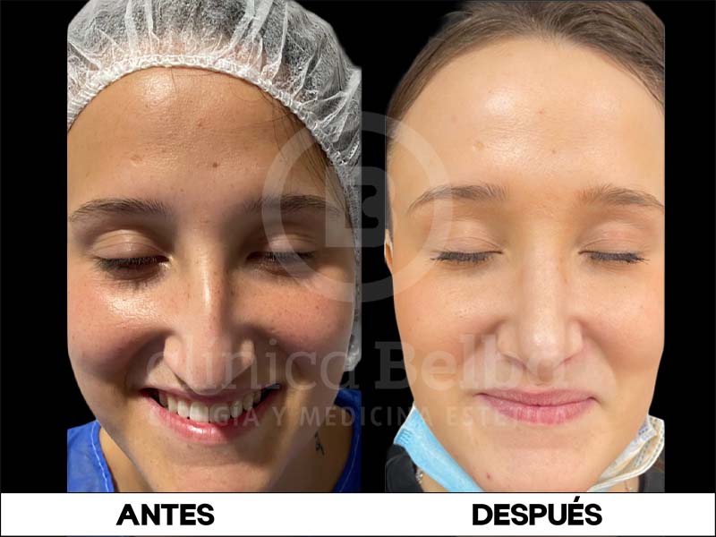 BelbaRinoplastia2