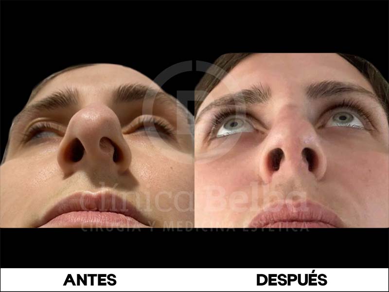 BelbaRinoplastia3