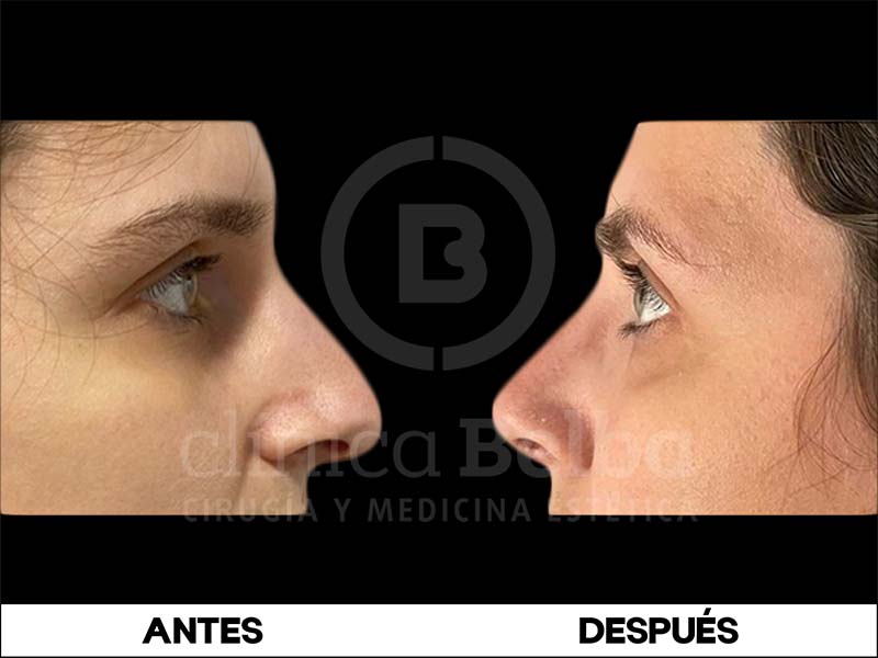 BelbaRinoplastia4