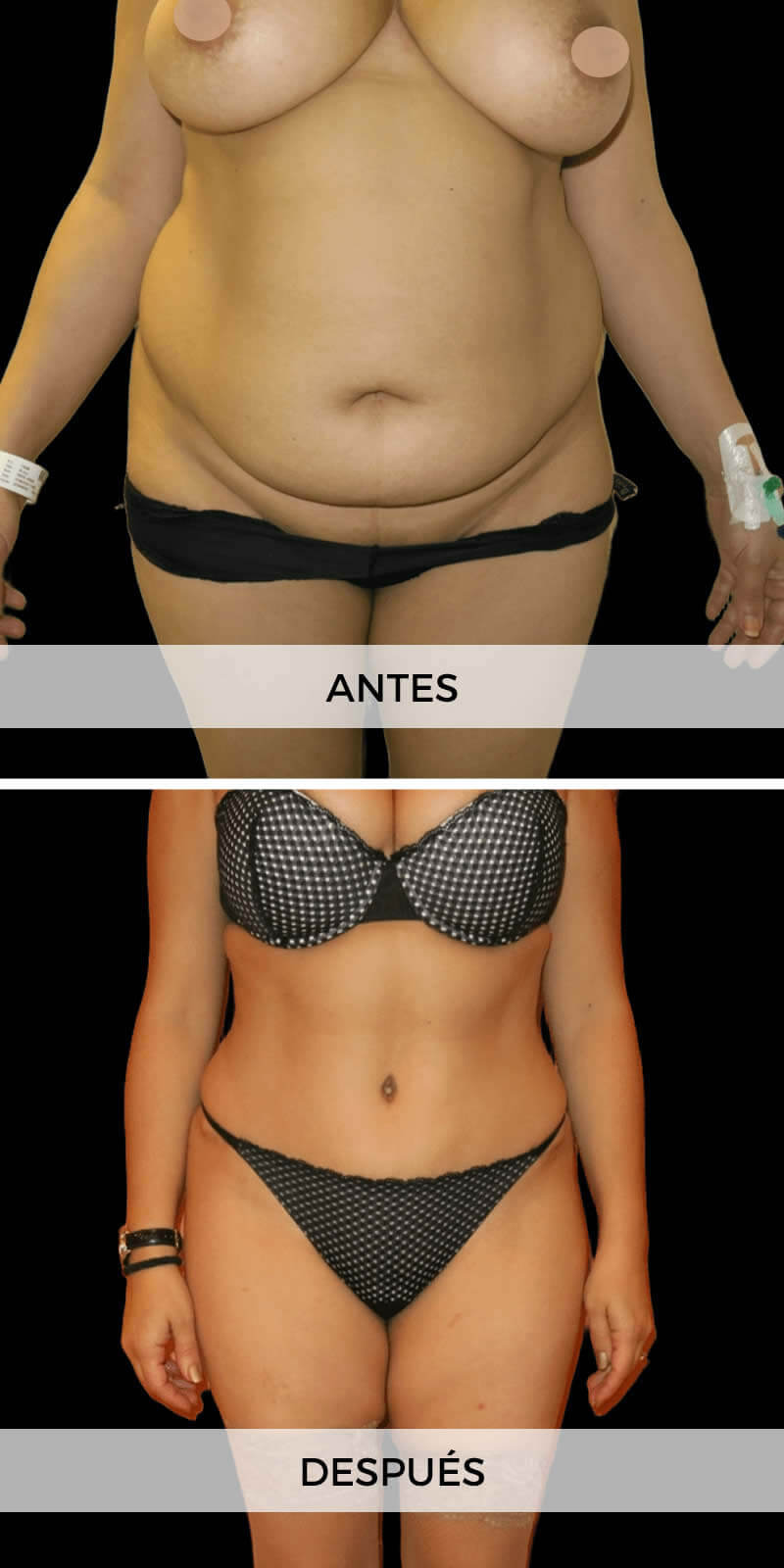 abdominoplastia-antes-despues-2