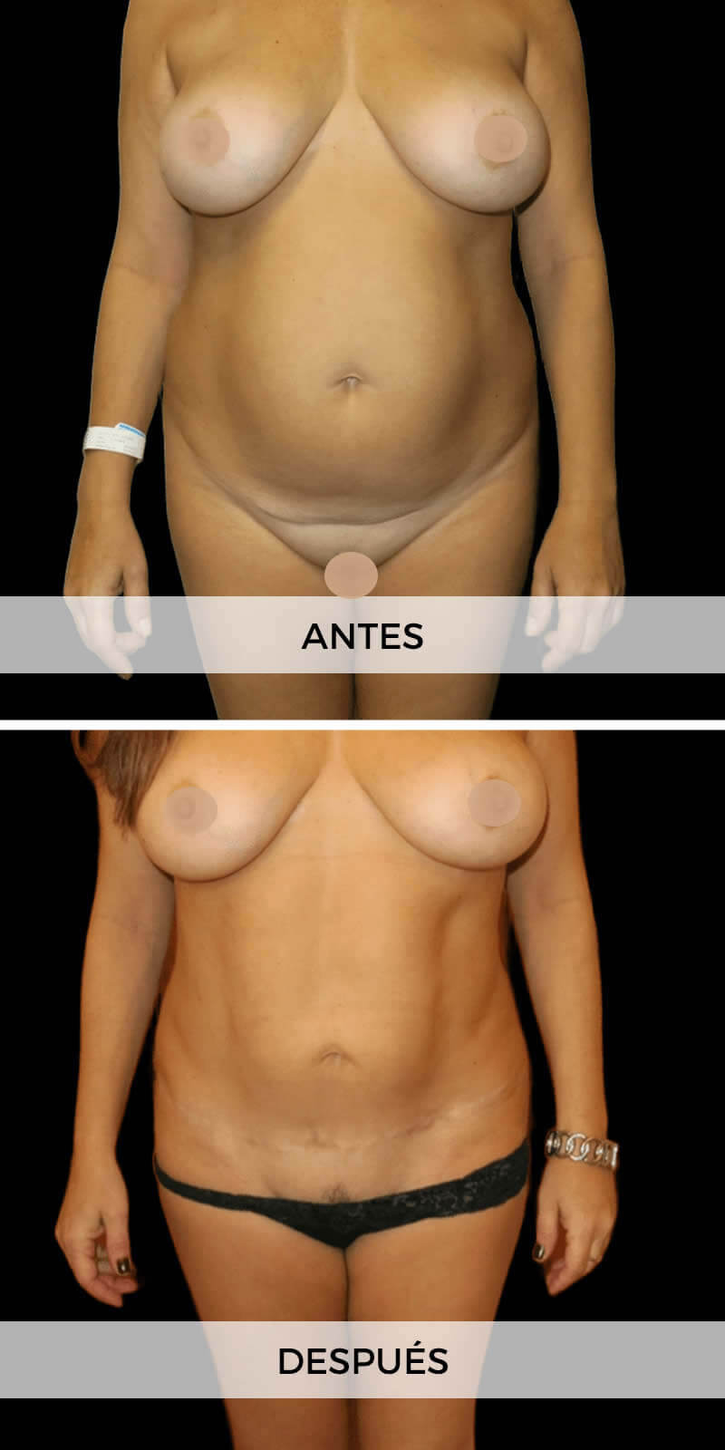 abdominoplastia-antes-despues-4