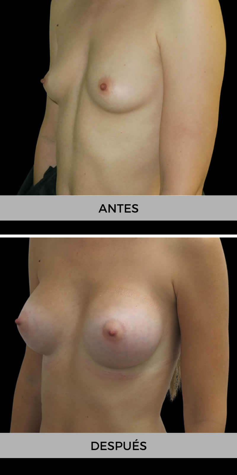 aumento-pecho-antes-despues-1