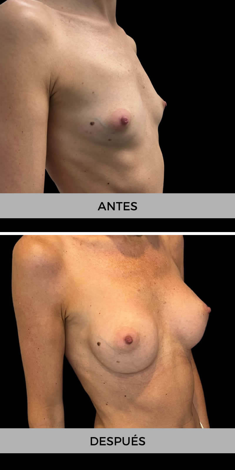 aumento-pecho-antes-despues-3