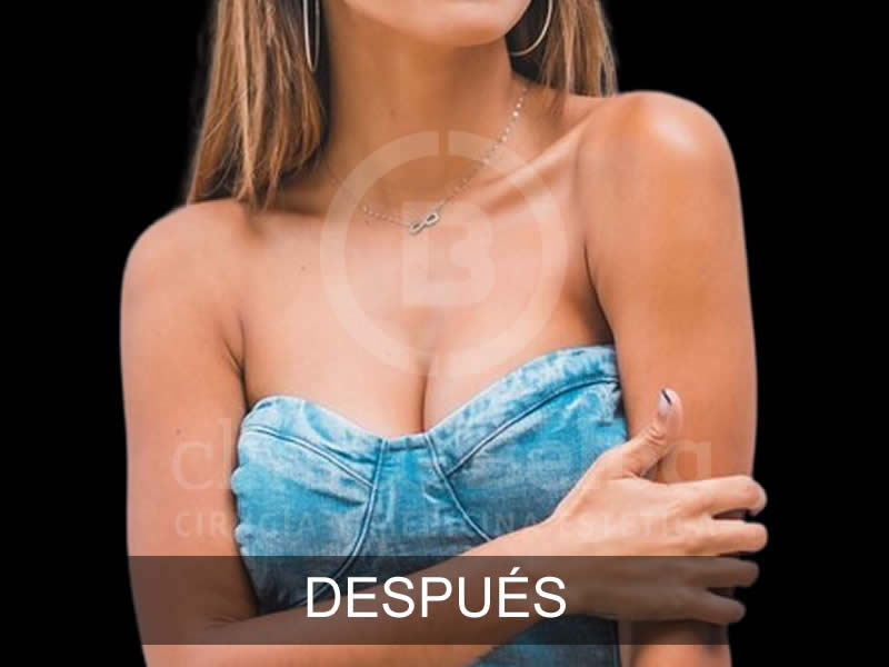 belba-aumento-armonia-1-despues-e