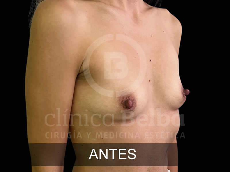 belba-aumento-armonia-12-antes