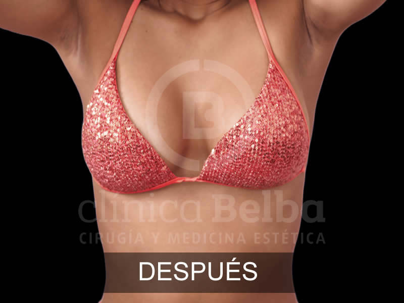 belba-aumento-armonia-12-despues-e