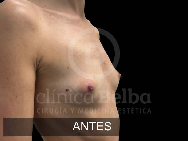 belba-aumento-armonia-3-antes